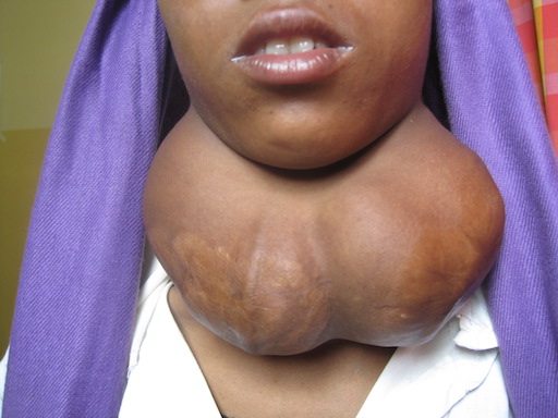 standard thyroid 512